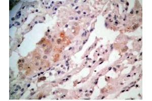 Human lung cancer tissue stained by Rabbit-Anti-GRP Pro (80-97) (H) Antibody (Gastrin-Releasing Peptide Antikörper  (AA 80-97))