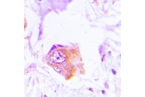 Immunohistochemical analysis of p47 phox staining in human lung cancer formalin fixed paraffin embedded tissue section.