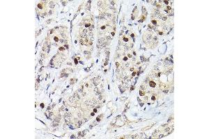 Immunohistochemistry of paraffin-embedded human breast cancer using RG Rabbit pAb (ABIN6127968, ABIN6146621, ABIN6220915 and ABIN6220916) at dilution of 1:50 (40x lens). (RACGAP1 Antikörper  (AA 353-632))