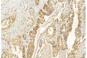 ABIN6260960 and ABIN6272912 at 1/100 staining Human normal tissues adjacent to colorectal cancer by IHC-P.