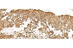 Immunohistochemistry of paraffin-embedded Human lung cancer tissue using PSMA3 Polyclonal Antibody at dilution of 1:50(x200) (PSMA3 Antikörper)