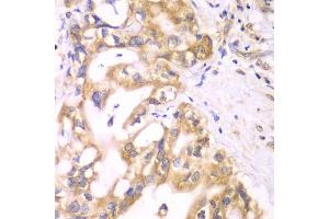 Immunohistochemistry of paraffin-embedded human liver cancer using ACADS antibody (ABIN5970342) at dilution of 1/100 (40x lens). (ACADS Antikörper)