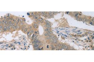 Immunohistochemistry of paraffin-embedded Human colon cancer tissue using P2RY11 Polyclonal Antibody at dilution of 1:30(x200)