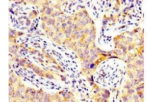 IHC image of ABIN7147182 diluted at 1:300 and staining in paraffin-embedded human pancreatic cancer performed on a Leica BondTM system. (CD82 Antikörper  (AA 111-228))