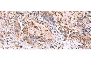 Immunohistochemistry of paraffin-embedded Human cervical cancer tissue using MPP1 Polyclonal Antibody at dilution of 1:50(x200) (MPP1 Antikörper)