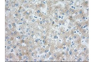 Immunohistochemical staining of paraffin-embedded Carcinoma of Human liver tissue using anti-H6PD mouse monoclonal antibody. (Glucose-6-Phosphate Dehydrogenase Antikörper)