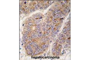 Formalin-fixed and paraffin-embedded human hepatocarcinoma tissue reacted with APOA2 antibody , which was peroxidase-conjugated to the secondary antibody, followed by DAB staining. (APOA2 Antikörper  (AA 28-56))