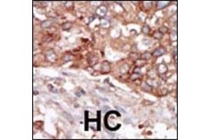 Formalin-fixed and paraffin-embedded human cancer tissue reacted with the primary antibody, which was peroxidase-conjugated to the secondary antibody, followed by AEC staining. (BLK Antikörper  (N-Term))