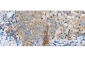 Immunohistochemistry of paraffin-embedded Human cervical cancer tissue using CLTB Polyclonal Antibody at dilution of 1:70(x200) (CLTB Antikörper)