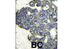 Formalin-fixed and paraffin-embedded human breast carcinoma reacted with PIK3CD polyclonal antibody  , which was peroxidase-conjugated to the secondary antibody, followed by DAB staining. (PIK3CD Antikörper  (N-Term))