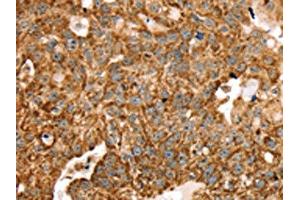 The image on the left is immunohistochemistry of paraffin-embedded Human breast cancer tissue using ABIN7192683(STK32B Antibody) at dilution 1/25, on the right is treated with synthetic peptide. (STK32B Antikörper)