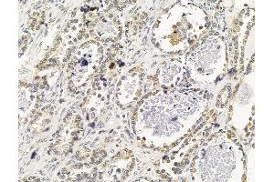 ABIN7095963 and ABIN7100025 at 1/100 staining human ovarian cancer by IHC-P.