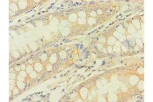 Immunohistochemistry of paraffin-embedded human colon cancer using ABIN7166896 at dilution of 1:100 (PDHA1 Antikörper  (AA 223-390))