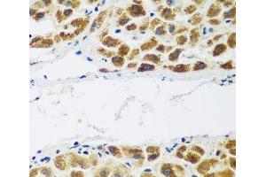 Immunohistochemistry of paraffin-embedded Human liver cancer using NAA60 Polyclonal Antibody at dilution of 1:200 (40x lens). (NAT15 Antikörper)