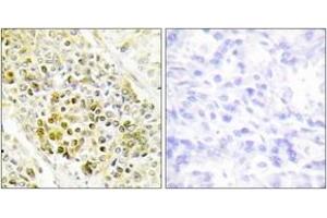 Immunohistochemistry analysis of paraffin-embedded human lung carcinoma tissue, using DLX5 Antibody. (DLX5 Antikörper  (AA 91-140))