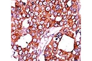 IHC analysis of FFPE human breast carcinoma tissue stained with the CDC25A antibody.