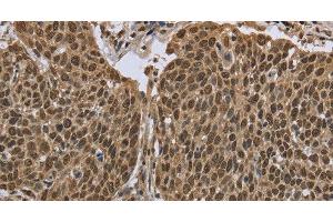 Immunohistochemistry of paraffin-embedded Human cervical cancer using PPAT Polyclonal Antibody at dilution of 1:50