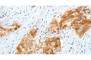 Immunohistochemistry of paraffin-embedded Human cervical cancer using ANXA8 Polyclonal Antibody at dilution of 1:35 (Annexin VIII Antikörper)
