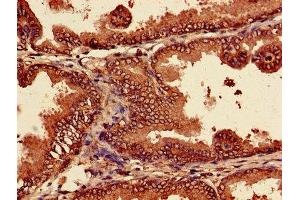 Immunohistochemistry of paraffin-embedded human prostate cancer using ABIN7164964 at dilution of 1:100 (PSMA7 Antikörper  (AA 5-232))