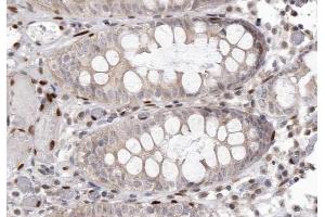 ABIN6267262 at 1/200 staining human colon carcinoma tissue sections by IHC-P.