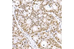 Immunohistochemistry of paraffin-embedded human colon carcinoma using Prdm9 Rabbit mAb (ABIN7269500) at dilution of 1:800 (40x lens). (PRDM9 Antikörper)