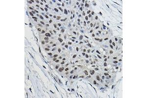 Immunohistochemistry of paraffin-embedded human lung cancer using BRAP Rabbit pAb (ABIN7265922) at dilution of 1:100 (40x lens). (BRAP Antikörper  (AA 1-200))