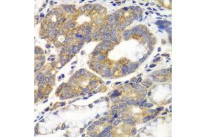 Immunohistochemistry of paraffin-embedded human gastric cancer using PFKM antibody at dilution of 1:100 (x40 lens).
