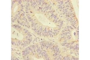 Immunohistochemistry of paraffin-embedded human colon cancer using ABIN7145574 at dilution of 1:100
