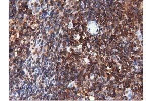 Immunohistochemical staining of paraffin-embedded Human lymphoma tissue using anti-ARHGAP25 mouse monoclonal antibody. (ARHGAP25 Antikörper)