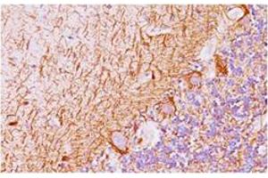 Immunohistochemical staining of human Ewing’s sarcoma with NKX2-2 monoclonal antibody, clone SPM564 .