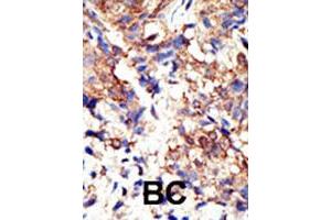 Formalin-fixed and paraffin-embedded human cancer tissue reacted with UBQLN2 polyclonal antibody  , which was peroxidase-conjugated to the secondary antibody, followed by DAB staining. (Ubiquilin 2 Antikörper  (N-Term))