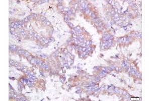 Formalin-fixed and paraffin embedded human lung carcinoma labeled with Rabbit Anti-ODC Polyclonal Antibody, Unconjugated (ABIN674559) at 1:200 followed by conjugation to the secondary antibody and DAB staining (ODC1 Antikörper  (AA 321-461))