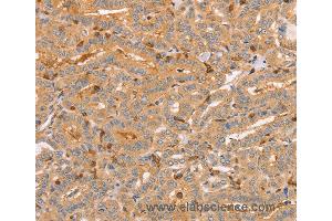 Immunohistochemistry of Human liver cancer using CCL16  Polyclonal Antibody at dilution of 1:60