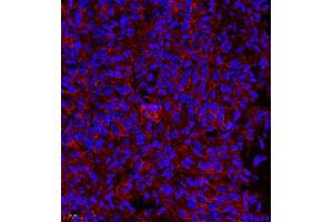 Immunofluorescence of paraffin embedded human bladder cancer using MYL6 (ABIN7074734) at dilution of 1:650 (400x lens) (MYL6 Antikörper)