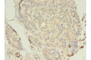 Immunohistochemistry of paraffin-embedded human breast cancer using ABIN7152043 at dilution of 1:100 (Estrogen Receptor alpha Antikörper  (AA 10-591))