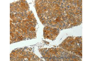 Immunohistochemistry of Human liver cancer using PTPN6 Polyclonal Antibody at dilution of 1:35 (SHP1 Antikörper)