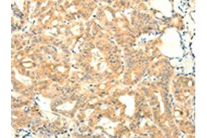 The image on the left is immunohistochemistry of paraffin-embedded Human thyroid cancer tissue using ABIN7131115(SNAP25 Antibody) at dilution 1/25, on the right is treated with fusion protein. (SNAP25 Antikörper)