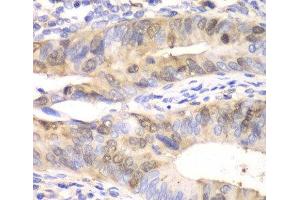 Immunohistochemistry of paraffin-embedded Human colon carcinoma using UBE2C Polyclonal Antibody at dilution of 1:100 (40x lens). (UBE2C Antikörper)