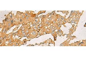 Immunohistochemistry of paraffin-embedded Human breast cancer tissue using CXCL1 Polyclonal Antibody at dilution of 1:35(x200)