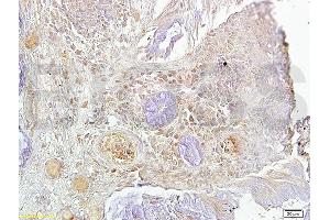 Formalin-fixed and paraffin-embedded human oral squamous cell carcinoma labeled with Rabbit Anti-Ki-67 Polyclonal Antibody, Unconjugated (ABIN677858) at 1:200 followed by conjugation to the secondary antibody and DAPI staining (Ki-67 Antikörper  (AA 1201-1300))