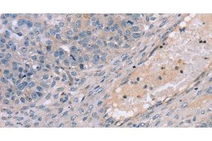 Immunohistochemistry of paraffin-embedded Human breast cancer using TERT Polyclonal Antibody at dilution of 1:35 (TERT Antikörper)