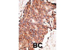 Formalin-fixed and paraffin-embedded human cancer tissue reacted with BMP1 polyclonal antibody  , which was peroxidase-conjugated to the secondary antibody, followed by AEC staining. (BMP1 Antikörper  (C-Term))