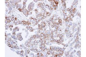 IHC-P Image Immunohistochemical analysis of paraffin-embedded OVCAR3 xenograft , using SNTB2, antibody at 1:500 dilution. (SNTB2 Antikörper)