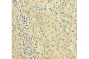 Immunohistochemistry of paraffin-embedded human liver cancer using ABIN7156085 at dilution of 1:100 (IGHG1 Antikörper  (AA 1-330))