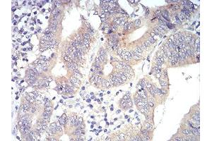 Immunohistochemical analysis of paraffin-embedded esophagus tissues using PLCG1 mouse mAb with DAB staining. (Phospholipase C gamma 1 Antikörper  (AA 1192-1291))