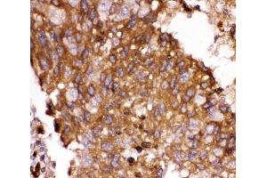 IHC-P: FOXO3A antibody testing of human lung cancer tissue (FOXO3 Antikörper  (AA 471-673))