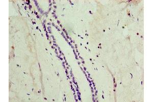 Immunohistochemistry of paraffin-embedded human breast cancer using ABIN7149025 at dilution of 1:100 (ATG4C Antikörper  (AA 259-458))