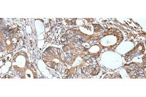 Immunohistochemistry of paraffin-embedded Human colorectal cancer tissue using APOD Polyclonal Antibody at dilution of 1:55(x200) (Apolipoprotein D Antikörper)