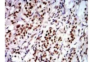 Immunohistochemical analysis of paraffin-embedded bladder cancer tissues using DDX1 mouse mAb with DAB staining. (DDX1 Antikörper  (AA 642-740))