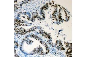 Immunohistochemical analysis of Lamin A/C (pS392) staining in human colon cancer formalin fixed paraffin embedded tissue section. (Lamin A/C Antikörper  (pSer392))
